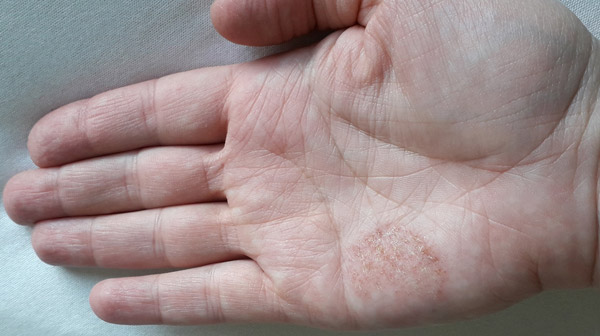 Bệnh tổ đỉa làm xuất hiện các mụn nước li ti trong lòng bàn tay